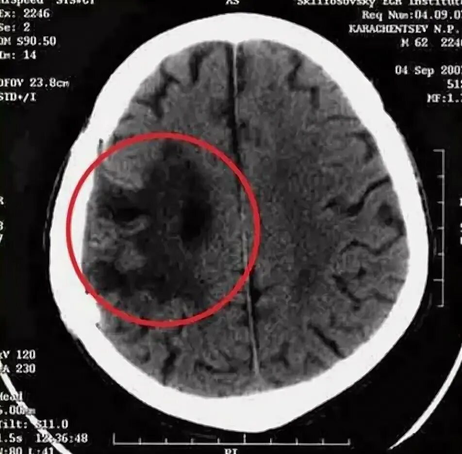 Киста головного мозга на кт. Черные пятна на мрт головного мозга. Темные пятна в мозгах на мрт. Киста сосудистого сплетения головного мозга кт.