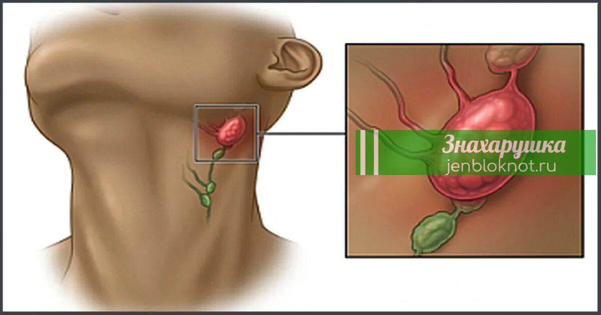 Почему часто воспаляется. Тонзилярный лимфоузлы. Воспалённые лимфоузлы. Как выглядят воспаленные лимфа узлы.