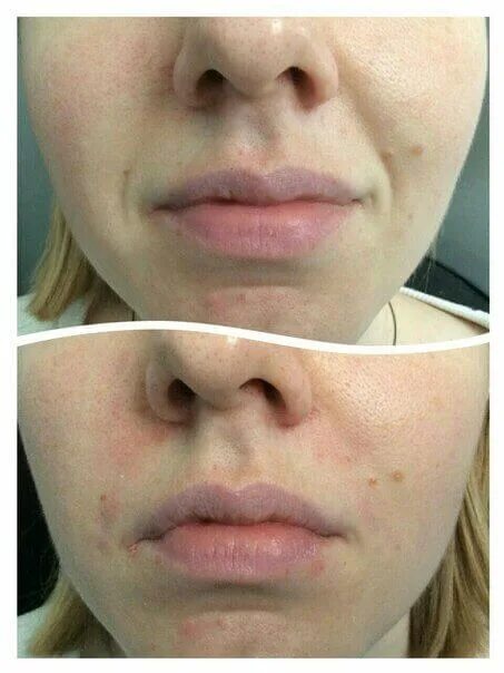 пластика носогубных складок. филеры в носогубные складки. филлеры носогубка. контурная пластика носогубки. рестилайн носогубные складки.