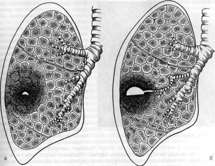 Образование полостей в легких