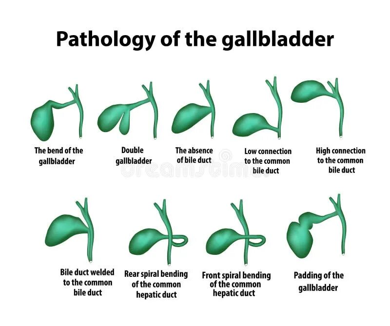 Желчный пузырь неправильной формы. Форма желчного пузыря с перегибом. S образный изгиб шейки желчного пузыря. S образная форма желчного пузыря. Желчный пузырь крючковидной формы.
