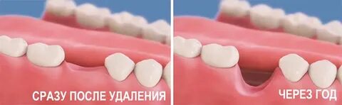 После удаления зуба когда можно в баню