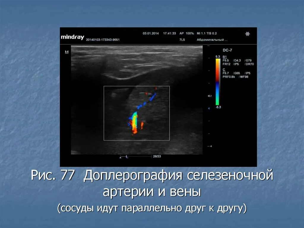 Расширение селезеночных вен. Норма селезеночной вены по УЗИ. Селезеночная Вена норма по УЗИ. Селезеночная артерия на УЗИ. Селезеночная Вена на УЗИ норма.