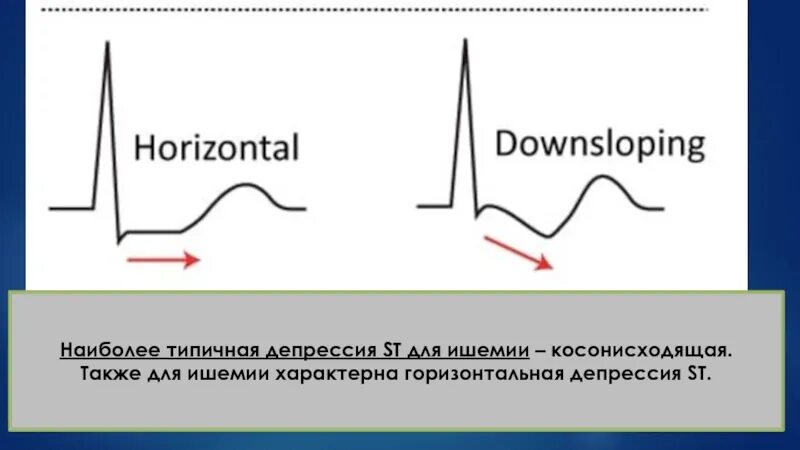 Эпизод депрессии st. Косонисходящая депрессия St на ЭКГ. Косонисходящая депрессия сегмента St. Косонисходящая депрессия сегмента St на ЭКГ. Горизонтальная депрессия St.