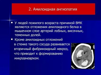 Мр картина проявлений микроангиопатии