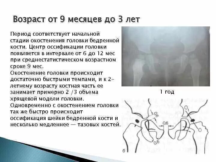 Норма углов тазобедренных. Дисплазия тазобедренных суставов ацетабулярный угол норма. сроки окостенения бедренной кости. ядра окостенения у детей сроки. формирования ядер окостенения.