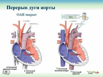 Правая дуга аорты