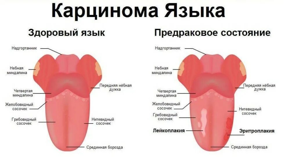 Язык признак какой болезни. Как выглядит онкология на языке сбоку.