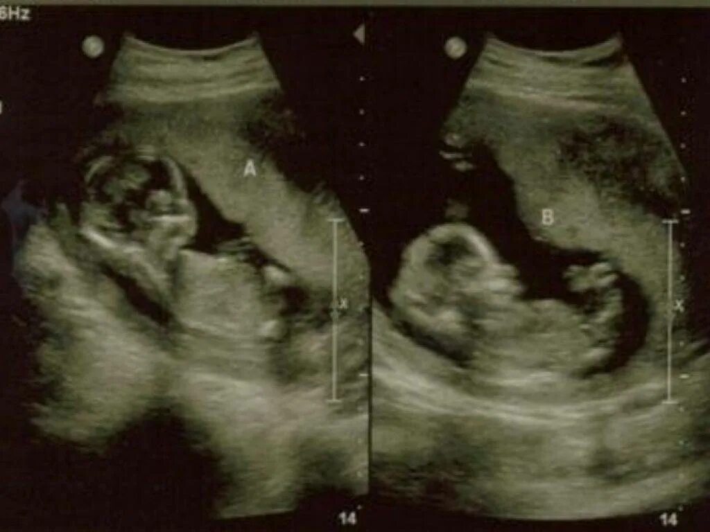 Малыш на 14 неделе. УЗИ двойни на 14 неделе беременности. УЗИ беременности двайня 15 недель. УЗИ 15 недель беременности двойня. УЗИ 13 недель беременности двойня.