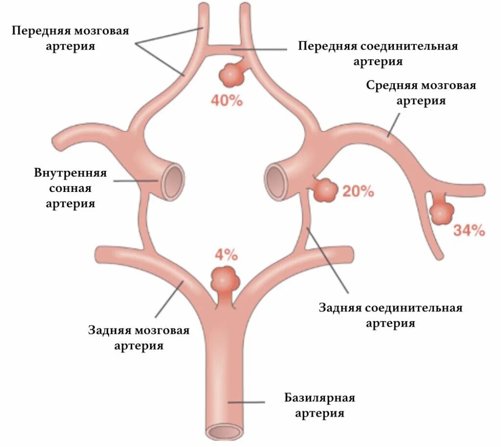 Неполная передняя трифуркация внутренней сонной артерии. Задняя трифуркация левой внутренней сонной артерии. Вариант развития валлизиева круга. Развитие виллизиева круга гипоплазия. Развитие виллизиева круга гипоплазия.