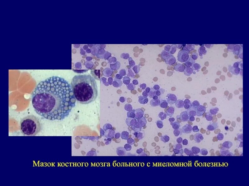 Метастазы в костном мозге