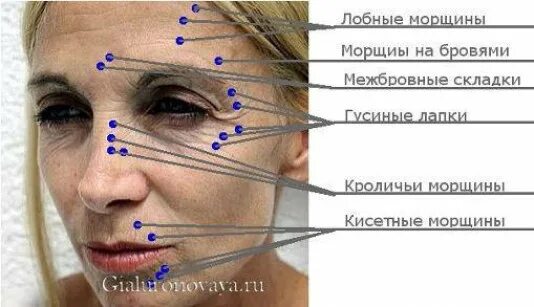 Точки для введения ботокса в межбровье. Схема уколов ботокса. Схема введения ботокса на лице. Схема уколов диспорта.