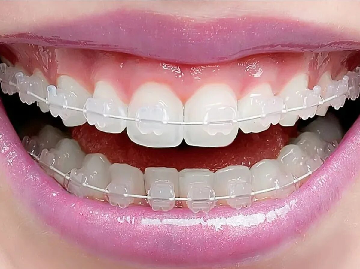 Брекеты и не только: 3 способа исправить прикус Журнал Startsmile о стоматологии