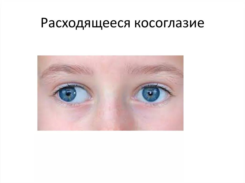 Почему у детей косоглазие. Расходящееся косоглазие. расходчщие касоглащие. расходящиеся косогдазие. расходяшие косрюоглазия.