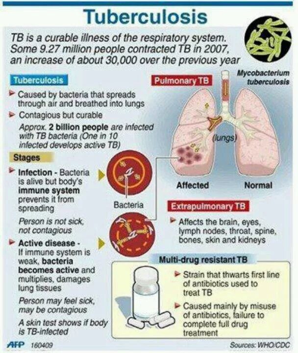 Tuberculosis disease. Prevention of tuberculosis. Tuberculosis disease. Tuberculosis disease. Types of tb.