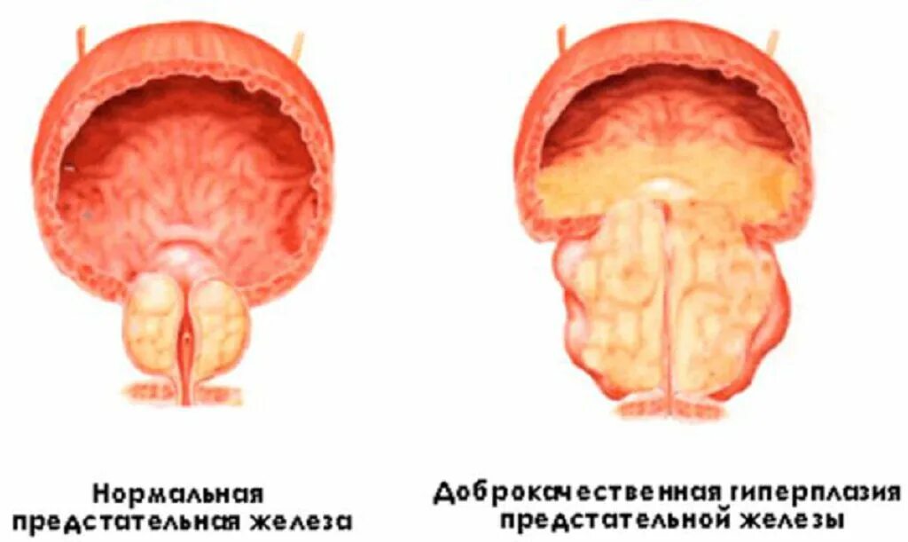 Диффузные предстательной железы. Нодозная гиперплазия предстательной железы что это. аденома предстательной железы и дгпж. доброкачественная узловая гиперплазия предстательной железы. доброкачественная гиперплазия предстательной железы (дгпж).