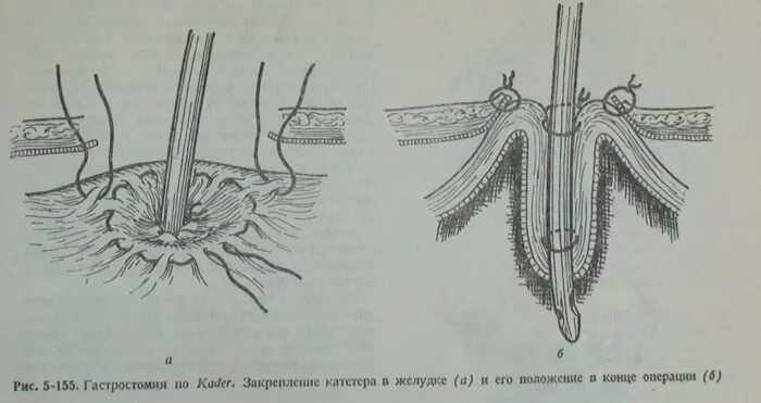 гастростома по кадеру. гастростома по кадеру. гастротомия и гастростомия. гастростомия по кадеру протокол операции. гастростома ход операции.