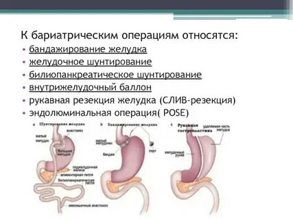 Кому делают бариатрическую операцию