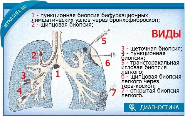 Пункционная биопсия легких. Трансторакальная биопсия легких. Трансбронхиальная биопсия легких. Биопсия легких как проводится