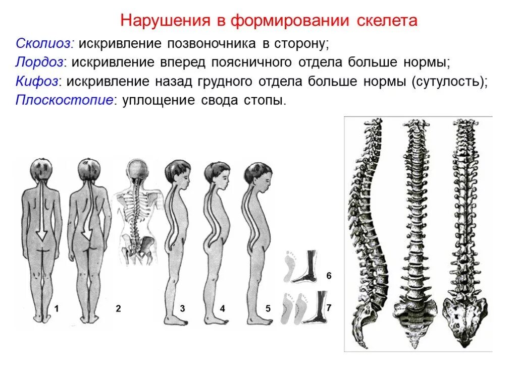 Облегченная работа какая. Скелет позвоночника лордоз кифоз. Искривление позвоночника кифоз и лордоз. Лордозы и кифозы скелет туловища человека. Деформации позвоночника кифоз лордоз сколиоз.