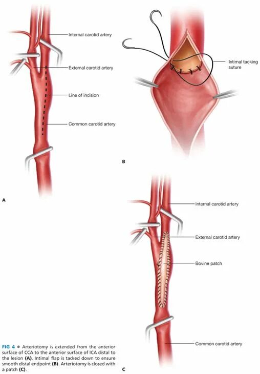 Эверсионная каротидная эндартерэктомия. Эверсионная эндартерэктомия сонной артерии. Эверсионная каротидная эндартерэктомия справа. Эндартерэктомия конечности этапы. Эндартерэктомия это