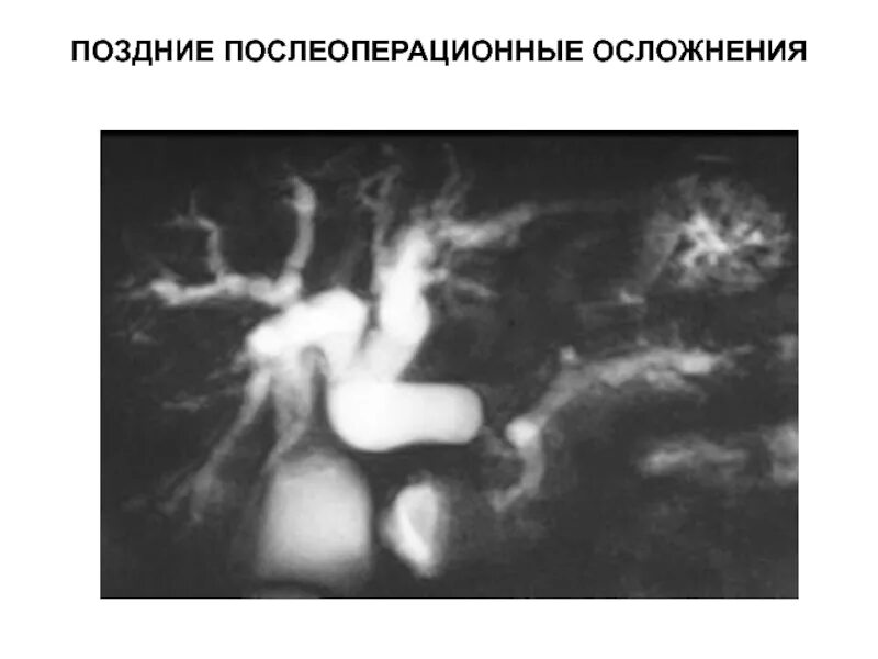 Хирургическая операция пред и послеоперационный период. Поздние осложнения после операции на легком. Согласно литературе поздних послеоперационных осложнений после КЭАЭ. Поздние послеоперационные осложнения