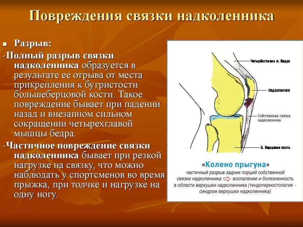 Связки надколенника сустава. Травма связки надколенника. Частичное повреждение связки надколенника. Частичный разрыв надколенника. Повреждение связки надколенника мрт.