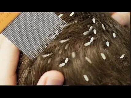Снятся вши на другом человеке