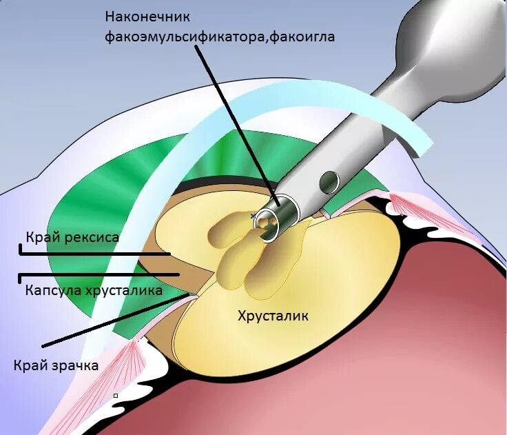 Катаракта факоэмульсификация. Факоэмульсификация с имплантацией интраокулярной линзы. Ультразвуковая факоэмульсификация с имплантацией ИОЛ. Факоэмульсификация катаракты с имплантацией ИОЛ. Что делать после операции по замене хрусталика