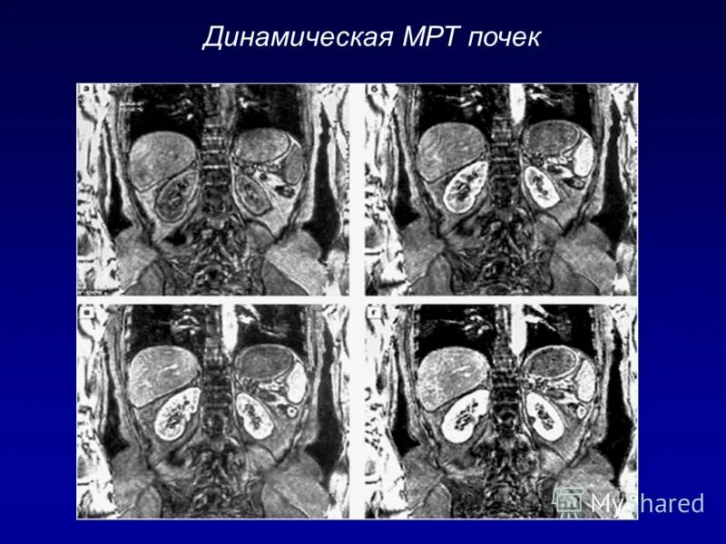 показания к мрт. динамическая мрт. динамическая мрт. мрт метастазы брюшнойтполости. динамическая кт.