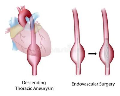 Aneurysm перевод