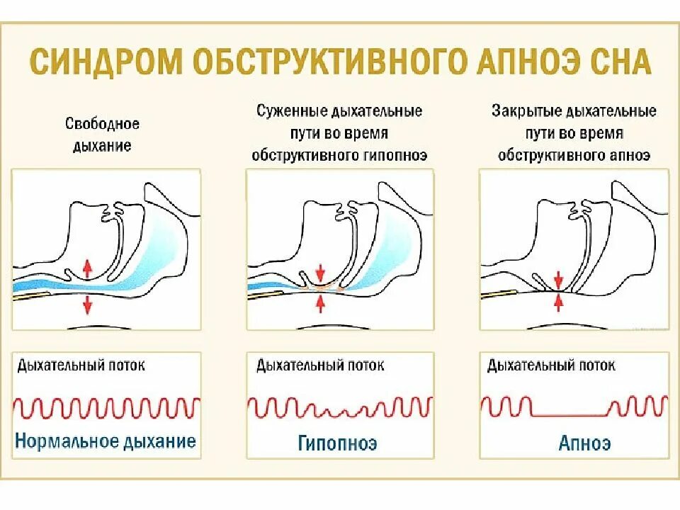 Синдром обструктивного апноэ сна. Синдром обструктивного апноэ сна у детей. соас синдром обструктивного апноэ сна. синдром обструктивного ап ноя сна.