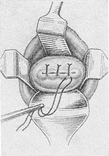 Ушивание разрывов. Операция Эммета пластика шейки матки. Пластика шейки матки при ИЦН. Ушивание разрыва шейки матки.