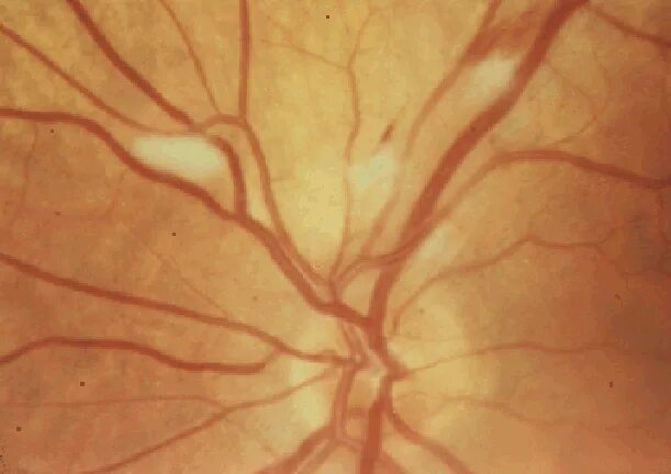 Оптическая ишемическая нейропатия ДЗН. Передняя ишемическая нейропатия зрительного нерва. Ишемическая нейропатия зрительного нерва. Нейрооптикопатия зрительного нерва.