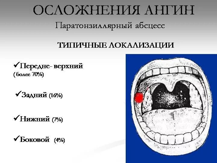 Абсцесс формы. Паратонзиллярный абсцесс. вскрытие паратонзиллярного абсцесса. перитонзиллярный абсцесс. паратонзиллярный абсцесс локализация.