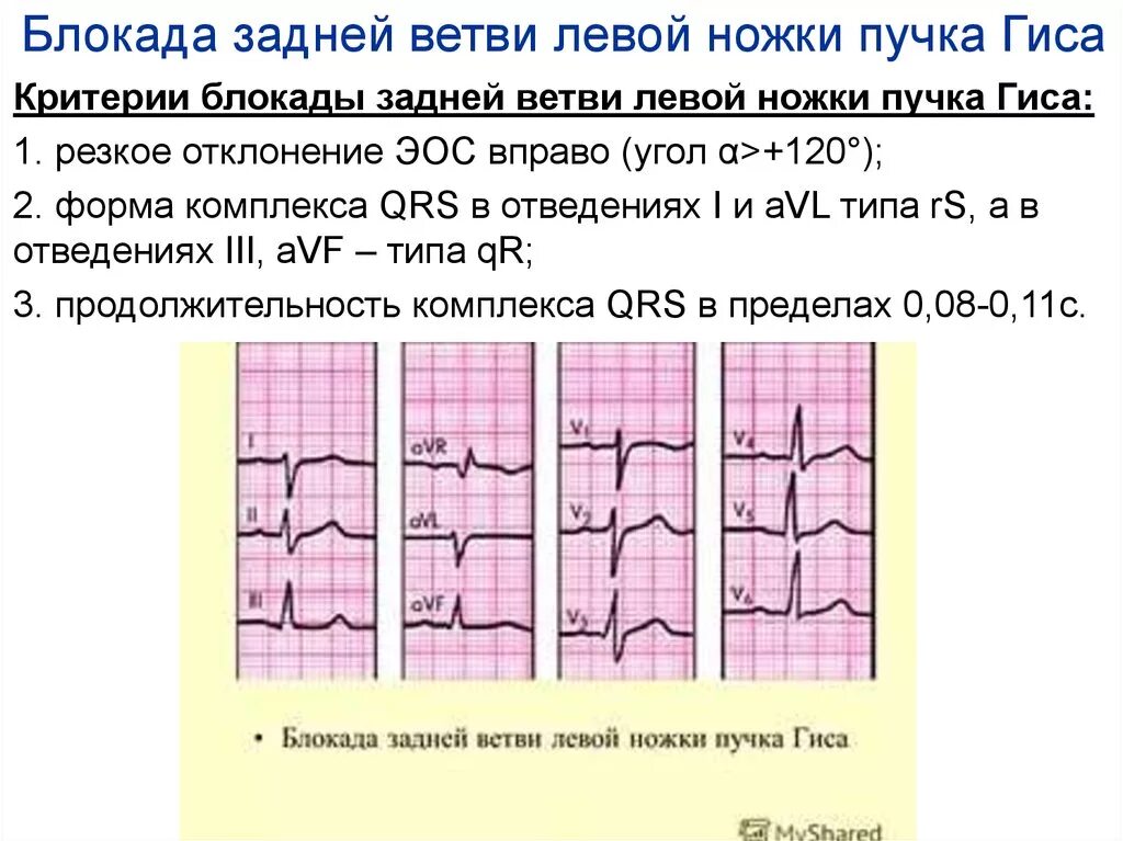 Блокада левой задней ножки. Неполная блокада задней ветви ЛНПГ. Блокада задней ветви левой ножки пучка Гиса на ЭКГ признаки. Блокада левой задней ветви на ЭКГ. Блокада задней ветви левой ножки пучка Гиса на ЭКГ ЭКГ.