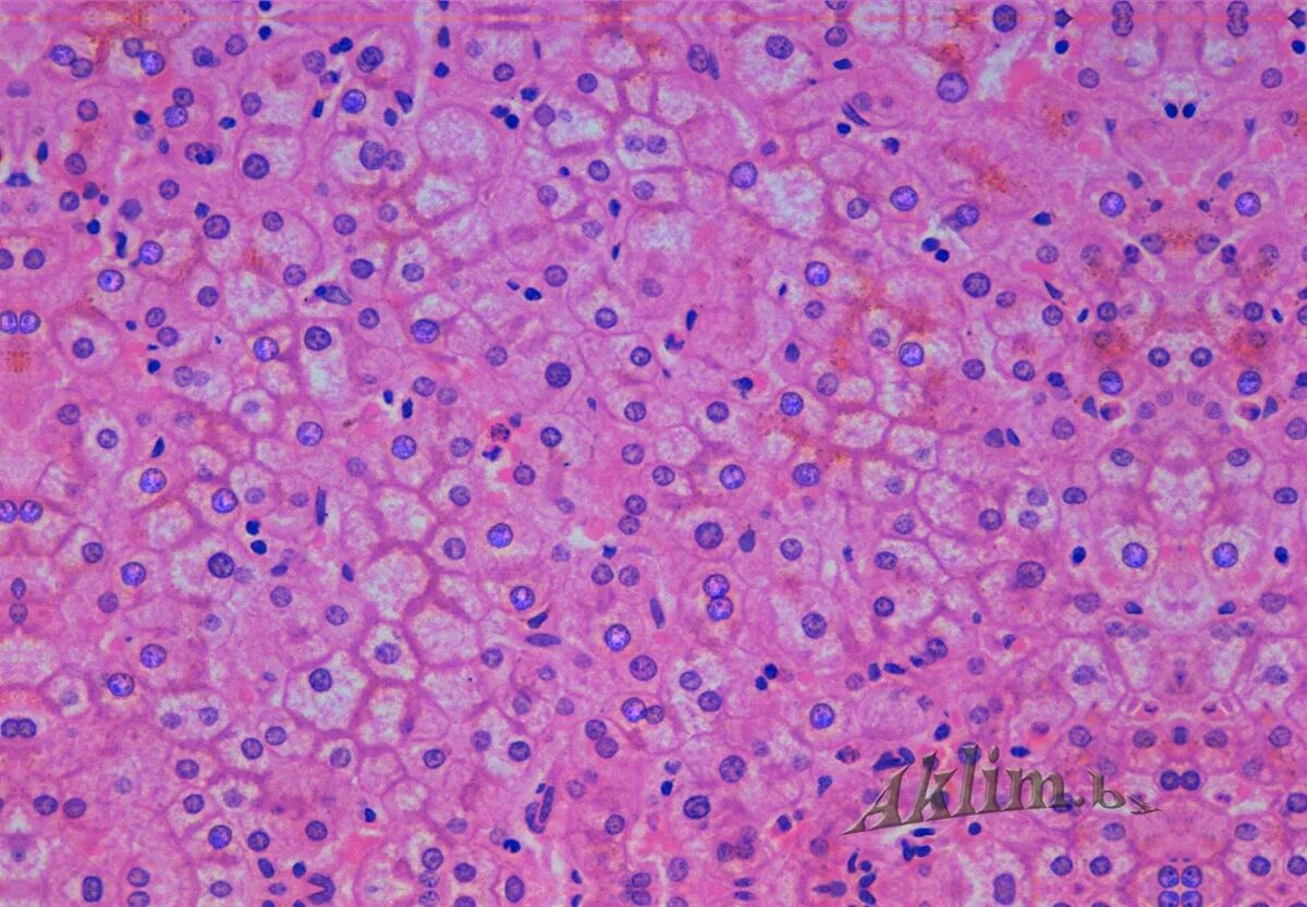 Клетки печени крыс. Некроз гепатоцитов гистология. Клетки печени гепатоциты. Некроз гистология клетки. Некроз гепатоцитов макропрепарат.