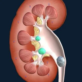 Формирование конкрементов в почках может быть обусловлено генетическими факторам