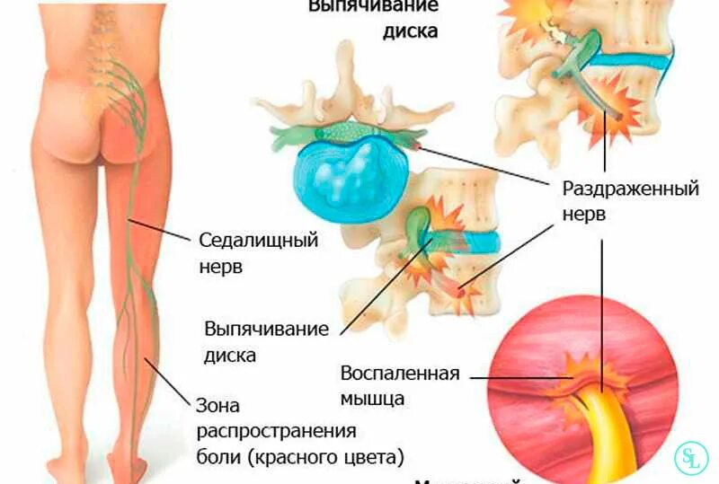 Зажата поясница. Неврит седалищного нерва. Воспаление седалищного нерва при протрузии. Седалищный нерв болит грыжа. Ишиас седалищного нерва симптомы.