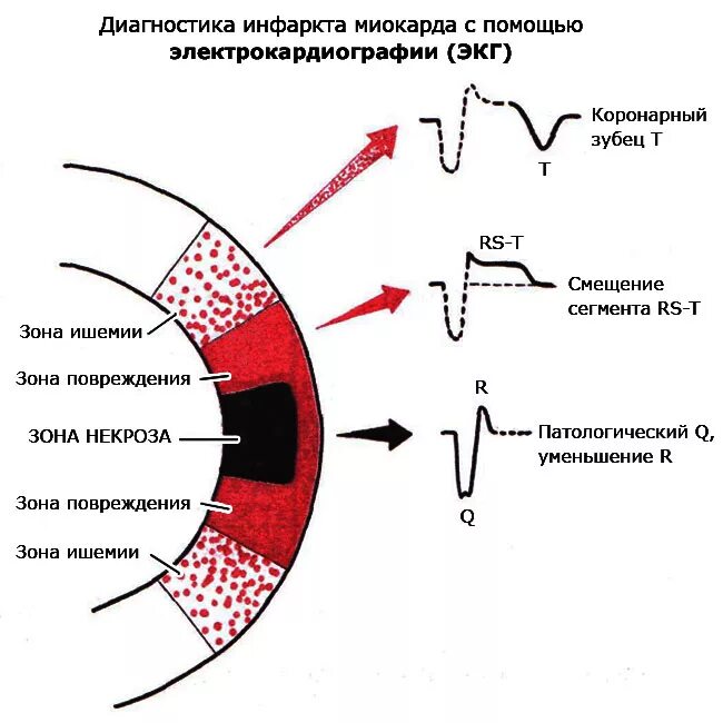 ЭКГ при инфаркте миокарда зона повреждения. Трансмуральный инфаркт миокарда схема. Острый инфаркт миокарда трансмуральный диагностика. Инфаркт миокарда зоны поражения. Зона ишемии