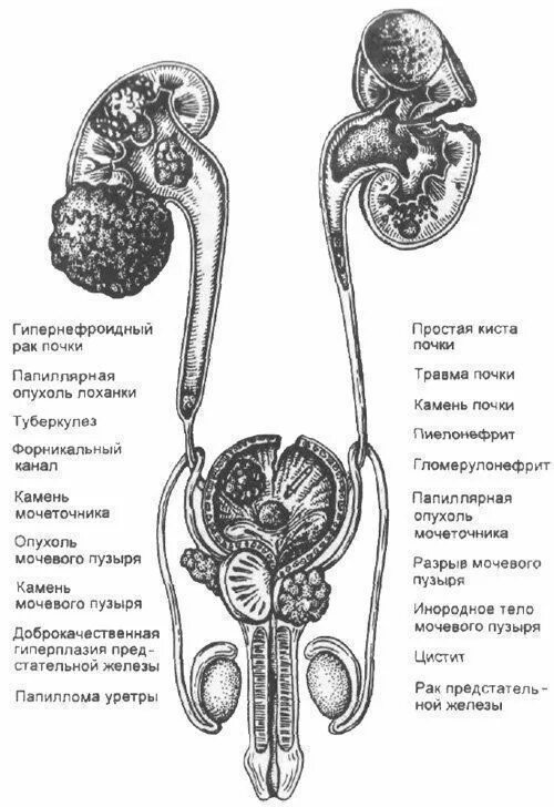 Собирается в почечную лоханку. Папиллярные опухоли мочеточника чаще всего встречаются:. Папиллярная опухоль мочеточника. Опухоли почечной лоханки и мочеточника. Опухоли мочеточника и мочевого пузыря.