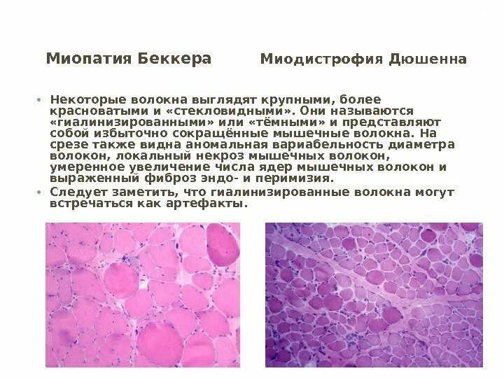 Миопатия беккера. Миодистрофия Дюшенна-Беккера симптомы. Скапулоперонеальная миопатия. Миодистрофия Дюшенна-Беккера патогенез. Мышечная дистрофия миопатия Дюшенна.