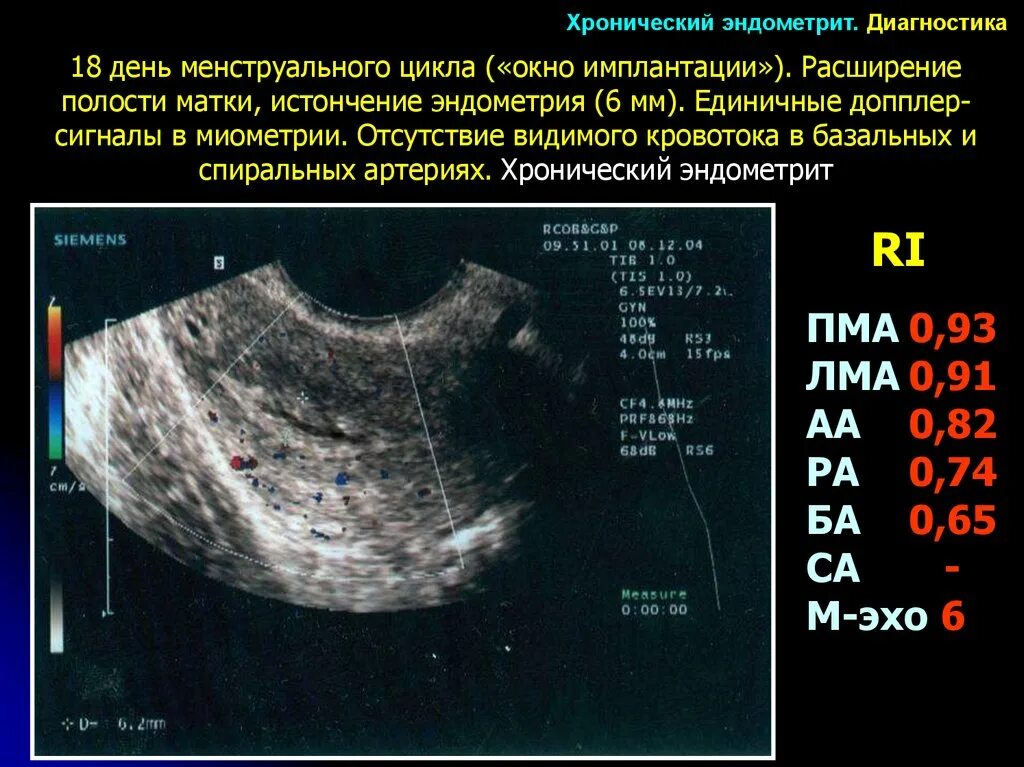 Норма полости матки. Эндометрий в полости матки норма на УЗИ. Эндометрий на 5 день цикла по УЗИ. Норма слоя эндометрия в матке.