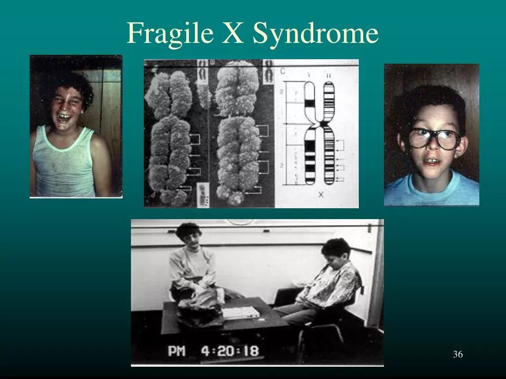 Fragile x