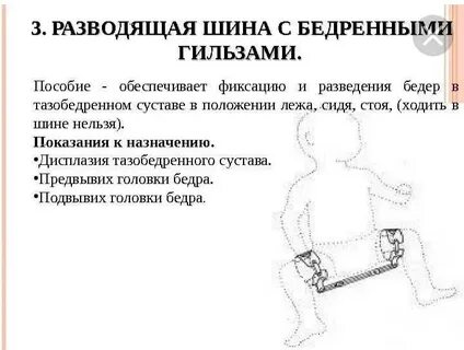 Дисплазия тазобедренного сустава шина
