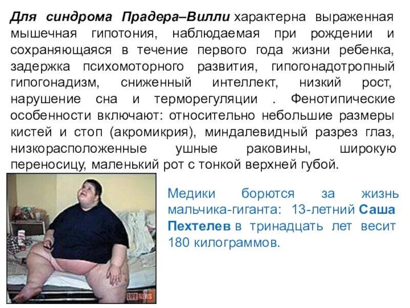 Синдром м р. Синдром прадера вилли клинические рекомендации. больные синдромом прадера вилли. синдром прадера вилли тип наследования. синдром прадера -вилли симптомы.