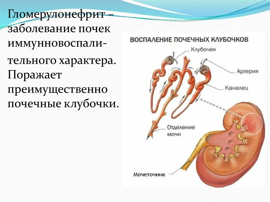 Гломерулонефрит почечный клубочек. Гломерулонефрит, нефрозонефрит.. Клубочки почек гломерулонефрит. Болезнь почек гломерулонефрит. Поражение клубочков почек