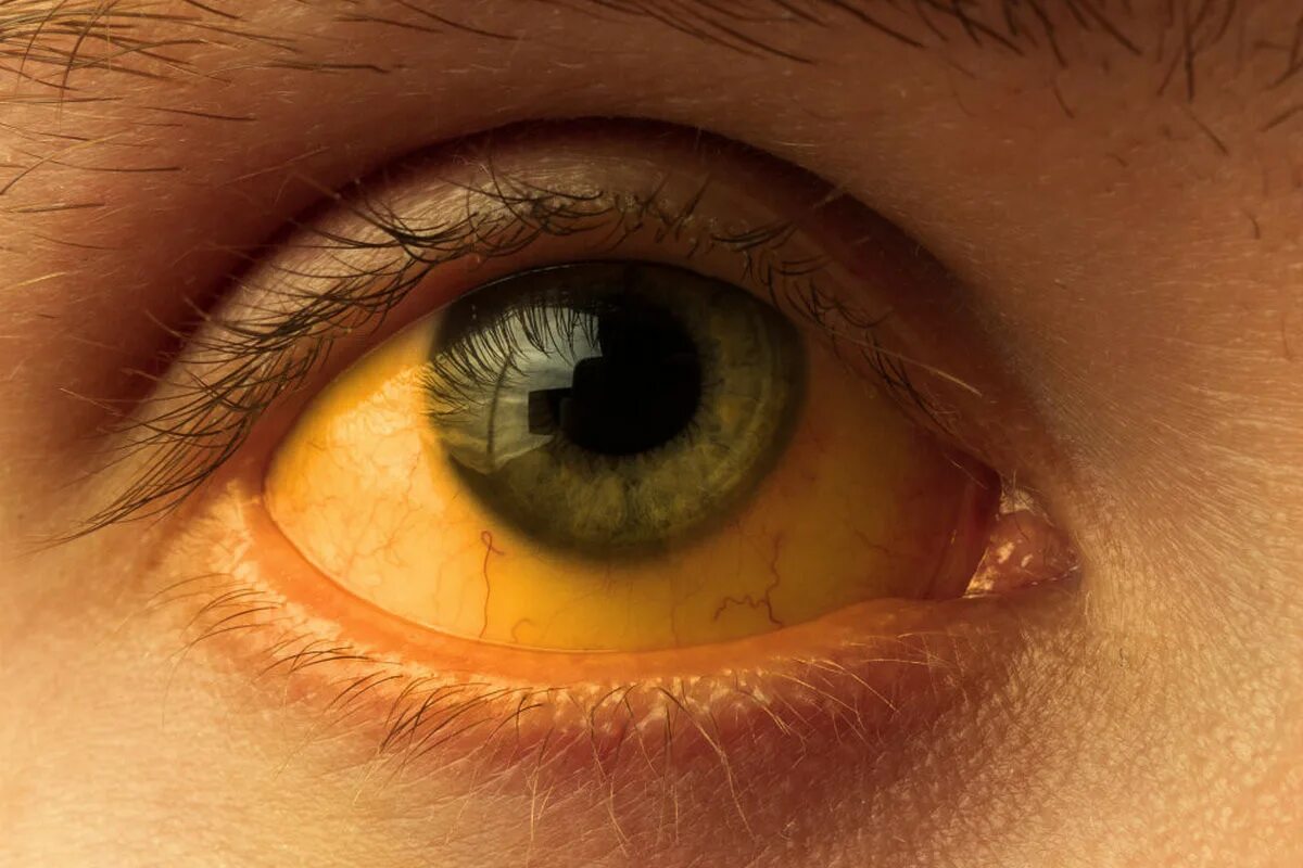 Желтый глаз 12. Иктеричность кожных склер.