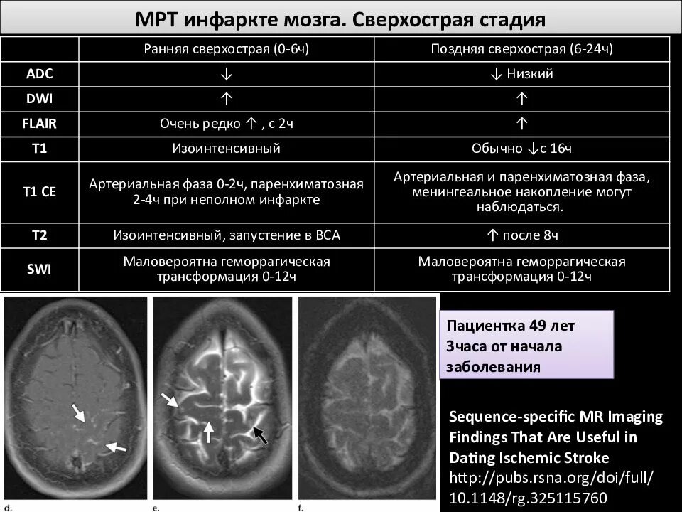 Ишемия мозга мрт. Фазы ишемического инсульта на кт. ОНМК по ишемическому типу периоды мрт. Стадии ОНМК мрт. Острый ишемический инсульт мрт.