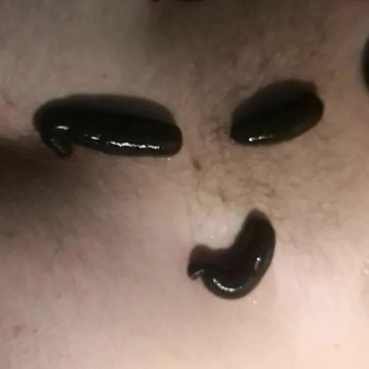 гирудотерапия иркутск